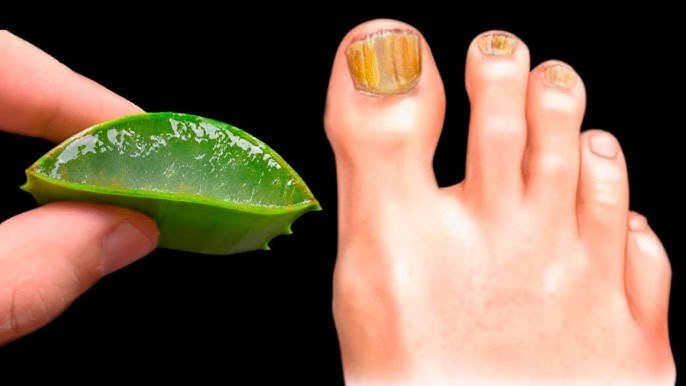 🔥Élimine IMMÉDIATEMENT la mycose des ongles ! Le meilleur remède ! Avantages de l&rsquo;Aloès ! 🌿😍